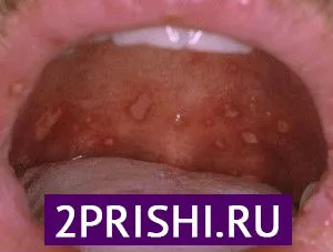 як вилікувати прищі у роті