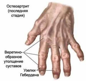 як лікувати артрит артроз