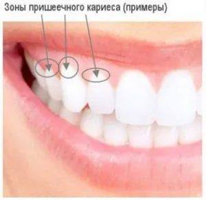 як лікувати карієс під яснами