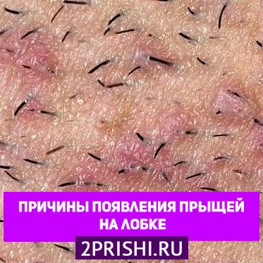 прищі на лобку як лікувати