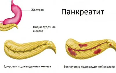 як лікувати тривалий пронос