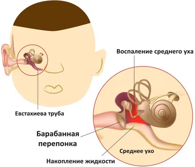 як лікувати вуха якщо продуло