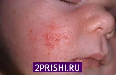 як вилікувати прищі на щоках у дитини