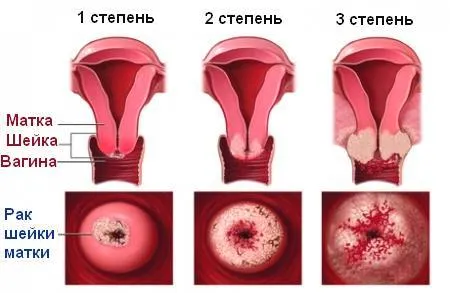 як лікувати рак шийки матки 4 стадії