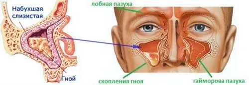 Профілактика гаймориту у дорослих хронічний гайморит профілактика
