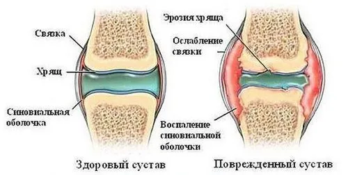 як лікувати суглоби бодібілдинг