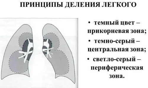 Прикоренева пневмонія - причини, симптоми, лікування прикоренева пневмонія у дітей дорослих симптоми лікування народними засобами правобічна лівостороння
