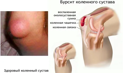 Препателлярний бурсит: що це таке, симптоми, лікування як лікувати препателлярний бурсит
