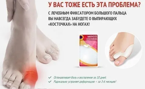 Поперековий радикуліт: наслідки, стадії, симптоми, причини і лікування, гімнастика і вправи поперековий радикуліт причини харчування симптоми лікування