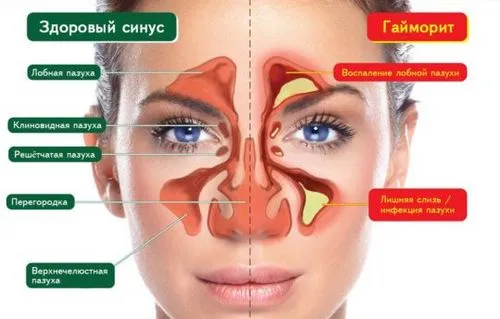 вухо гайморит закладеність