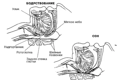як лікувати жіночий хропіння