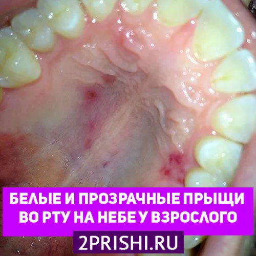 як вилікувати прищі у роті