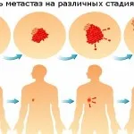 як вилікувати рак 4 стадії з метастазами