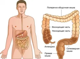 як лікувати рак товстої кишки
