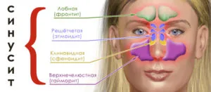 Риніт, синусит і гайморит в чому різниця як лікувати риніт синусит