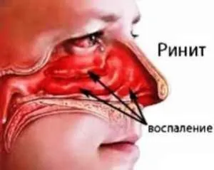 Риніт, синусит і гайморит в чому різниця як лікувати риніт синусит