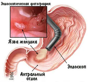 Рефлюкс гастрит гострої форми лікувати рефлюкс гастрит