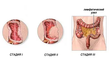 як лікувати рак товстої кишки