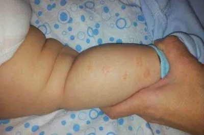 чи може бути псоріаз у грудничка фото
