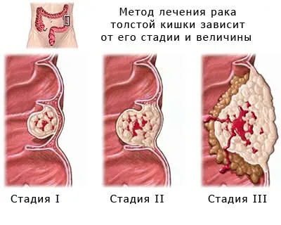 як лікувати рак сигмовидної кишки