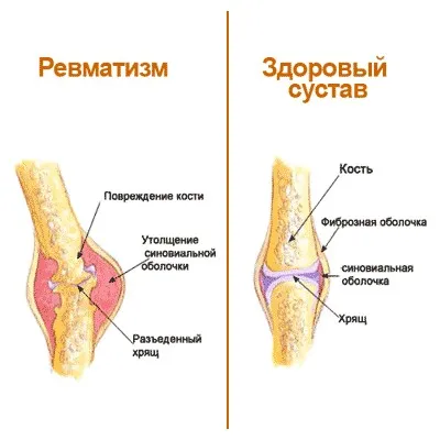 ревматизм стрептококова інфекція поворотний ревмокардит ревматична пневмонія запалення судини плеврит абдомінальний синдром хорея патологія серце