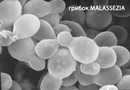 як лікувати себорею на тілі