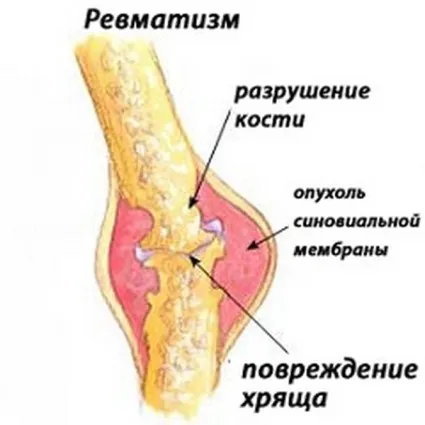 Ревматизм: симптоми і лікування як лікувати ревматизм рук