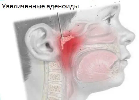 симптоми аденоїдів лімфоїдна тканина