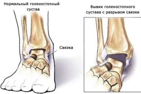 як лікувати розтягнення стопи