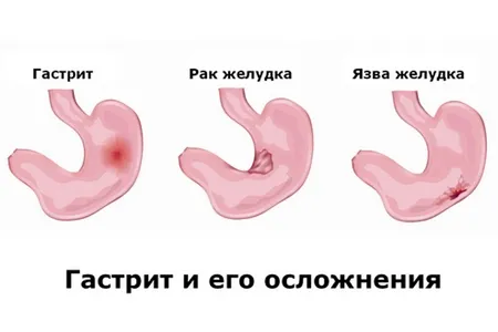 як лікувати діарею і блювоту