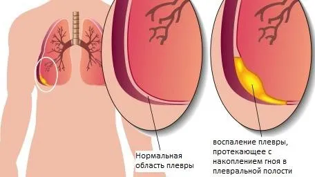 ревматизм стрептококова інфекція поворотний ревмокардит ревматична пневмонія запалення судини плеврит абдомінальний синдром хорея патологія серце