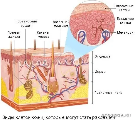 рак шкіри лікується чи ні