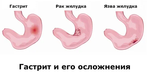 Рефлюкс гастрит гострої форми гастрит рефлюкс