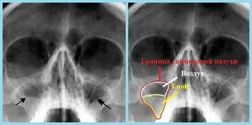 хронічний гайморит на знімку