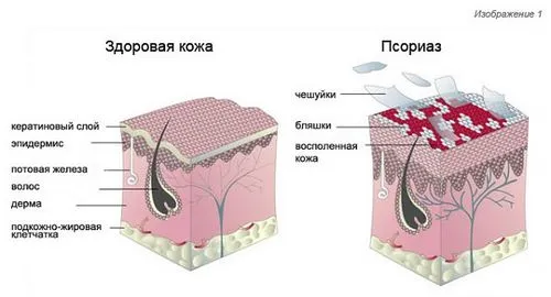 Псоріаз: причини виникнення, види та методи лікування як лікувати точковий псоріаз