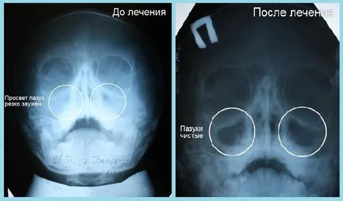 хронічний гайморит на знімку
