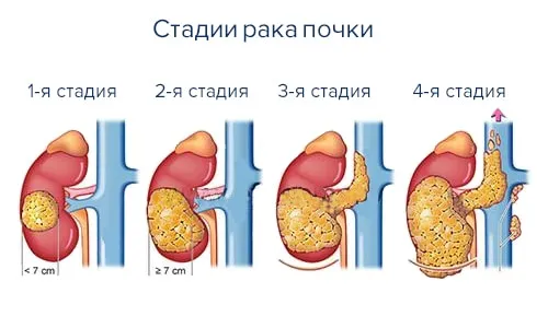 Рак нирки: важлива інформація про перебіг і лікування як вилікувати нирки швидко