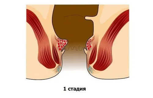 лікувати геморой на ранній стадії