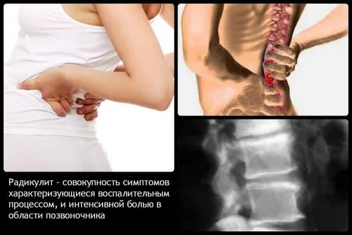 Радикуліт: що робити при болях як довго лікувати радикуліт