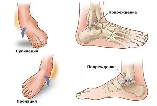 як лікувати розтягнення зв'язок гомілкостопу
