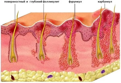 як лікувати жировик на вусі
