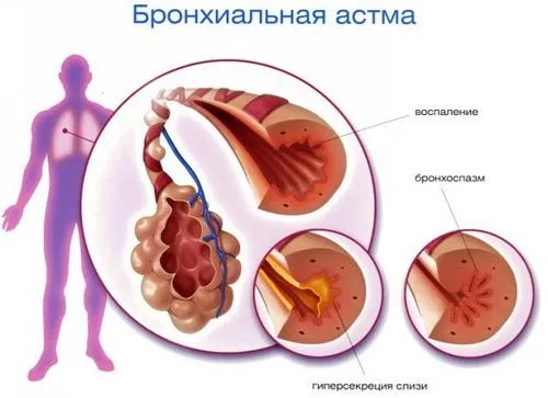 чи можна лікувати серцеву астму