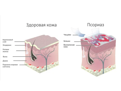 як лікувати псоріаз шкіри голови