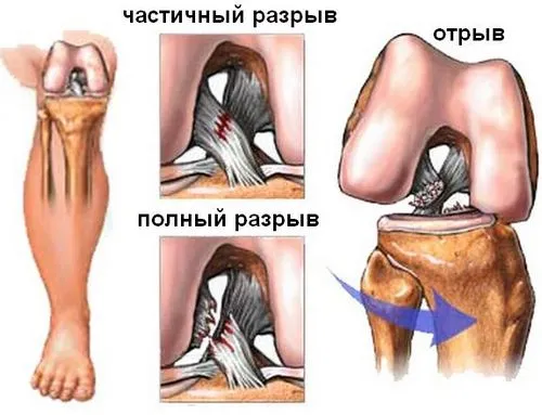 розрив