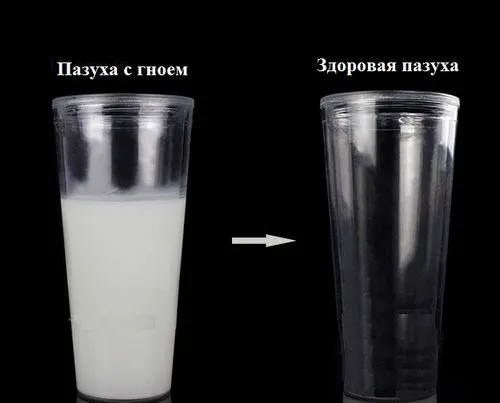 хронічний гайморит на знімку