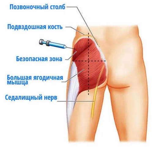як швидко лікувати забій сідниці