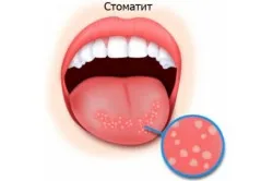 як лікувати хворобу стоматит