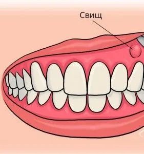 як лікувати свищ ясна