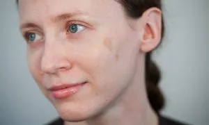 як лікувати стрептодермії у дорослих