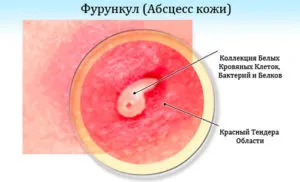 як лікувати фурункул в початковій стадії
